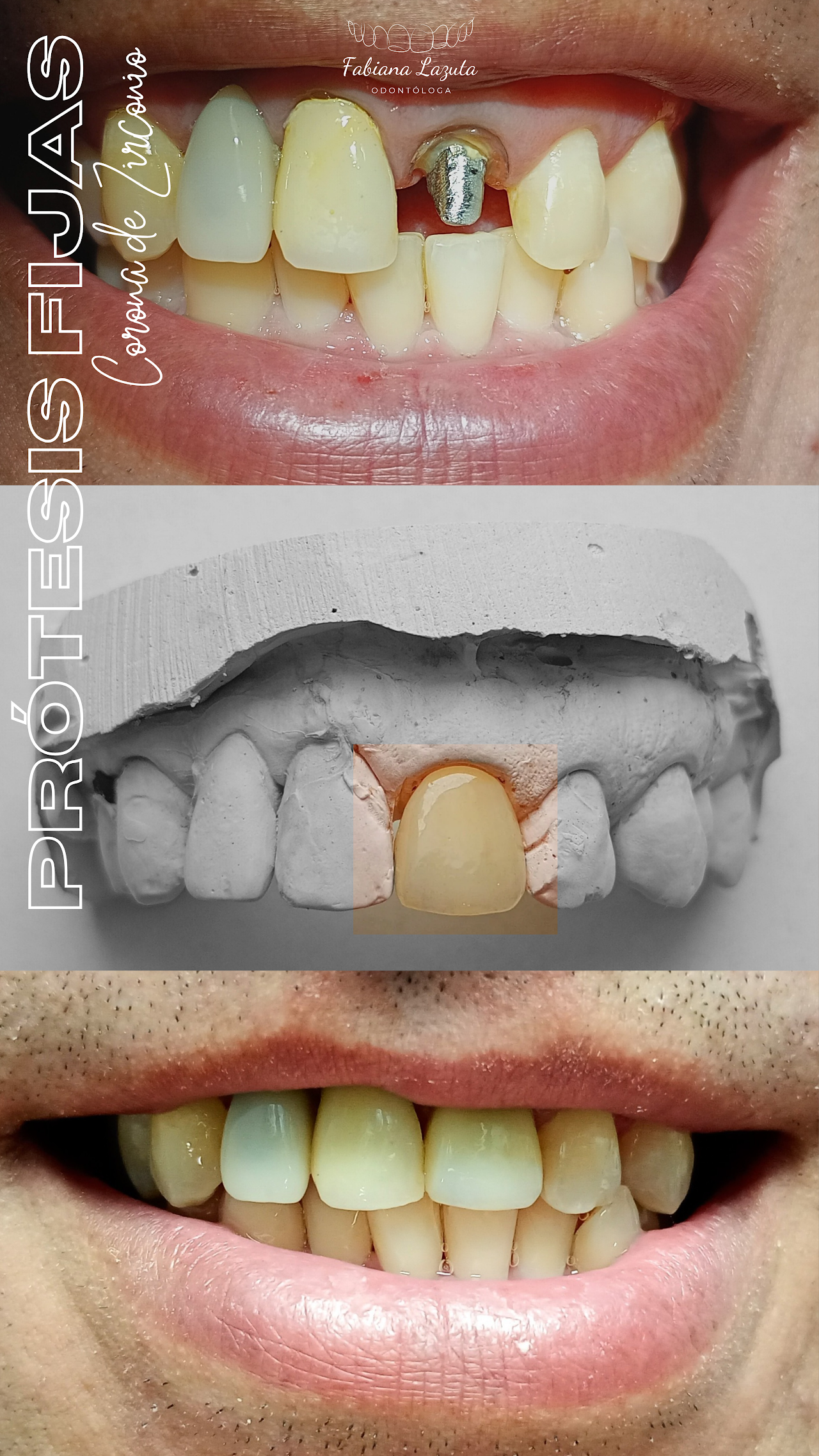 Coronas de zirconio y prótesis cerámicas en modelo